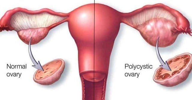 Polycystic Ovarian Syndrome: Diet Plan for Indian Women