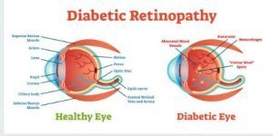 Can you reverse diabetic retinopathy